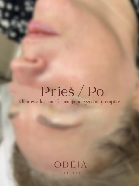 Šiose nuotraukose matote klientės odos būklę prieš ir po egzosomų terapijos.

Pokytis nėra drastiškas – tai tarpinis rezultatas po vienos procedūros. Būtent tai rodo, kad dirbame su odos kokybe, o ne su momentiniu efektu.

Matomas:
▫️ ramesnis odos tonas
▫️ sumažėję paraudimai
▫️ tolygesnė tekstūra
▫️ sveikesnis bendras vaizdas

Egzosomų terapija skatina natūralius regeneracijos procesus ląstelių lygiu. Oda palaipsniui stiprėja, gerėja jos atsparumas, atkuriamas balansas.

Tai procesas. Ir kiekviena procedūra – žingsnis link stipresnės, gyvybingesnės odos.

Jeigu jaučiate, kad oda tapo jautresnė, linkusi į paraudimus ar praradusi gyvybingumą – galbūt jai tiesiog reikia natūralaus atsinaujinimo ir tinkamos priežiūros.

📩 Jei norite pradėti savo odos gerinimo kelią – parašykite asmeninę žinutę.

🤎
#rezultatai #sveikaoda #odosprieziura #odėja #kosmetologe