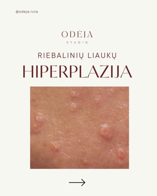 Riebalinių liaukų hiperplazija dažnai atrodo kaip mažas spuogelis, bet tai nėra užsikimšusi pora.

Dažnai ji būna odos spalvos ar gelsva, blizgesnė, kartais primena mažą „spurgytę“ — su lengvu įdubimu centre. Būtent todėl ją lengva supainioti su spuogu.

Svarbiausia: nespausti.
Ji neišsispaudžia kaip spuogas, o spaudimas gali tik sudirginti odą, palikti paraudimą ar pažeisti barjerą.

Jei pastebite tokius mažus iškilimus kaktos, nosies ar skruostų srityje — verta įsivertinti, kas tai iš tikrųjų.

Išsisaugokite, jei buvo naudinga 🤎

#odosprieziura #kosmetologe #veidoodosprieziura #brandioda #riebalinesliaukos