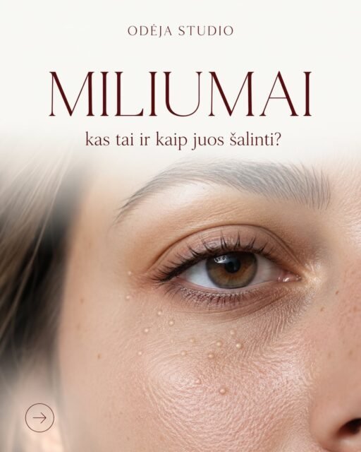Mažas, baltas ir labai užsispyręs.
Ne, ne spuogas. Miliumas 🤎
#kosmetologe #sveikaoda #miliumai #odosprieziura #patarimai